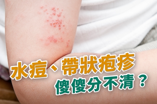 水痘、帶狀疱疹傻傻分不清?