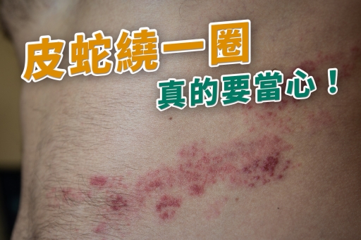 皮蛇繞一圈真的要當心!