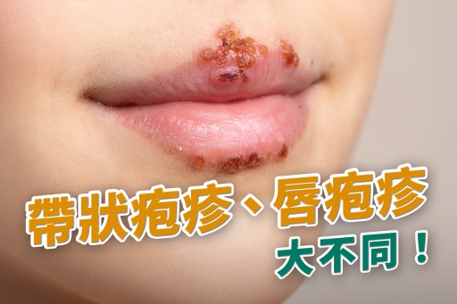 帶狀疱疹、唇疱疹大不同!