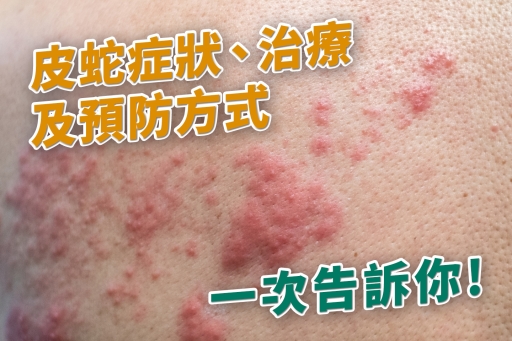 皮蛇症狀、治療及預防方式一次告訴你！