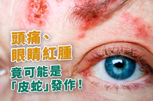 頭痛、眼睛紅腫竟可能是「皮蛇」發作！