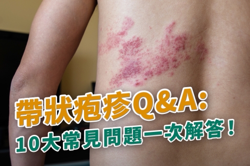 帶狀疱疹Q&amp;A：10大常見問題一次解答！