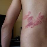 帶狀疱疹常見症狀