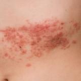 帶狀疱疹可能復發